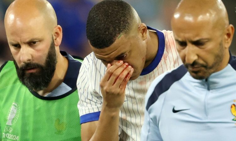 Mbappe z zlomljenim nosom, a ne bo potreboval operacije