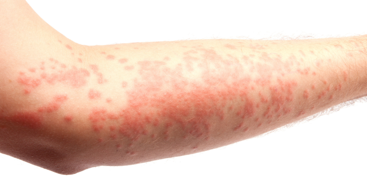 Ob dnevu melanoma opozorila o zaščiti pred soncem